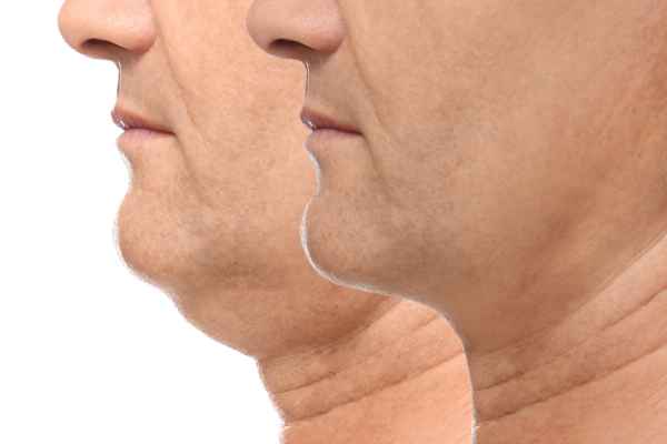 HIFU - Breakthrough in Anti - ageing 2 hifu results Trowbridge