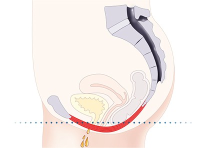 Pelvic-Floor Muscle Repair 5 Pelvic floor muscles Trowbridge