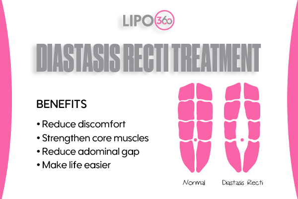 Revolutionising Muscle Repair: The Power of LIPO360 Body Sculpt Post-Injury 5 diastasis recti treatment Trowbridge
