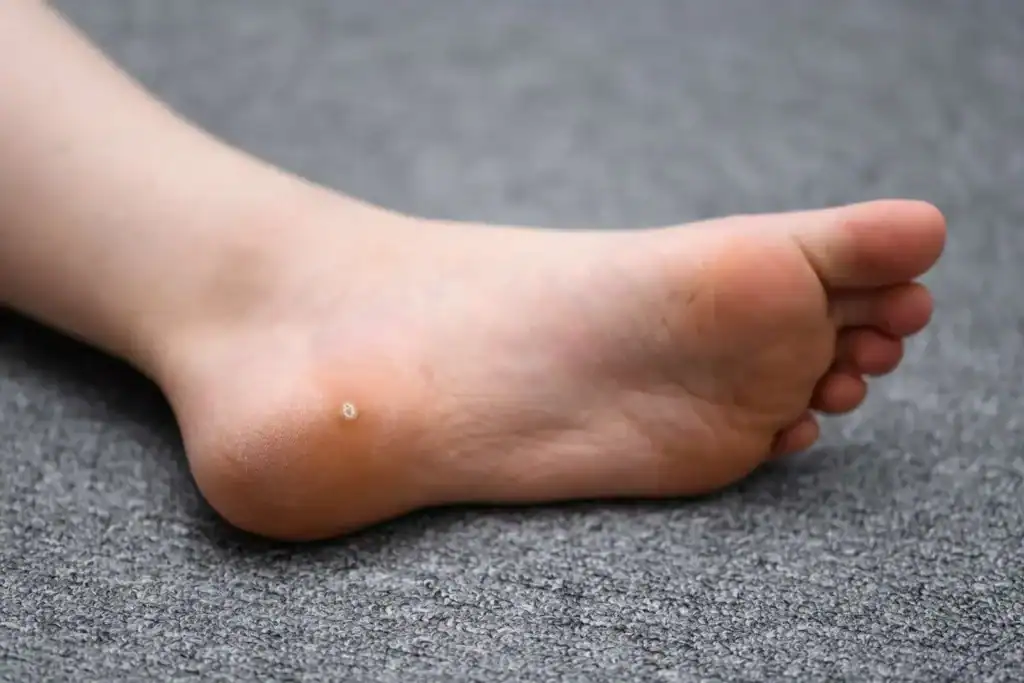 Cryotherapy For Warts And Also Verrucas 2 Image of verruca on the bottom of the foot that able to be treated with Cryotherapy Trowbridge