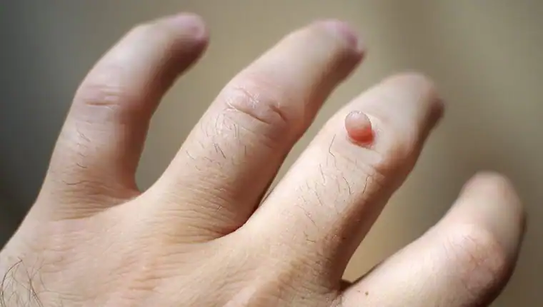 Cryotherapy For Warts And Also Verrucas 1 Image of blemish that Cryotherapy Trowbridge can remove with Lipo 360.