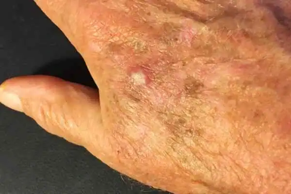Image of Actinic keratoses Trowbridge on a person hand