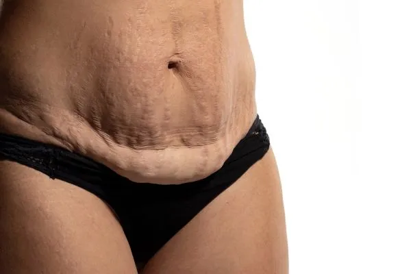 The science behind skin tightening Trowbridge picture of a woman's sagging skin on the stomach